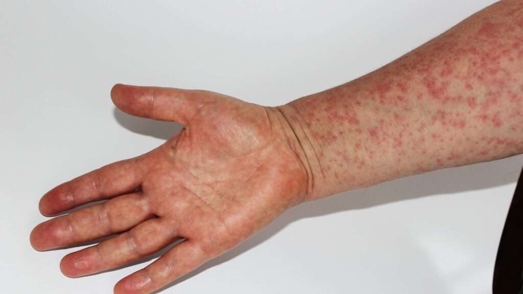 Measles Cases Surge 5x In US In A Week, CDC Reports: Outbreak Primarily Originating From A Texas County